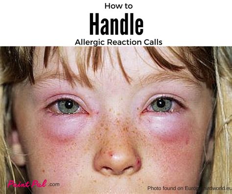 How to Handle an Allergic Reaction Call