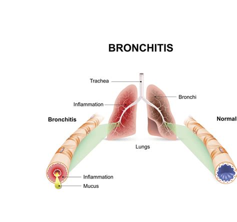 Acute Bronchitis - Harvard Health