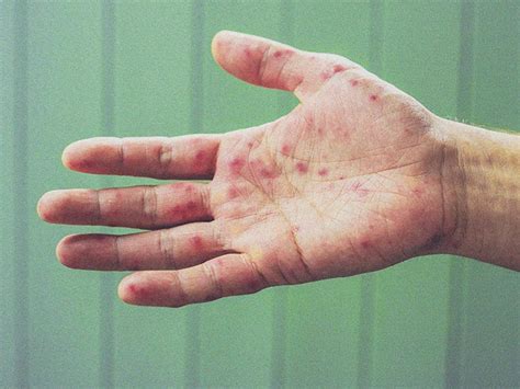 Palm rash: Causes, pictures, and treatments