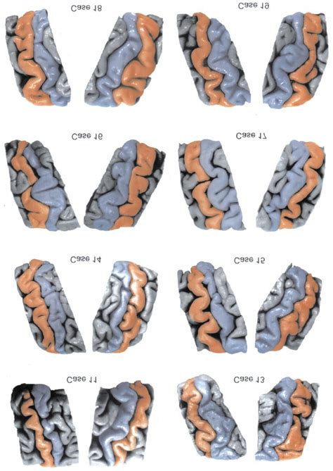 The superficial appearance of the left and right central sulci in eight ...