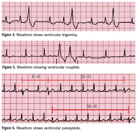 Evaluation and Management of Ventricular Premature Beats | Consultant360