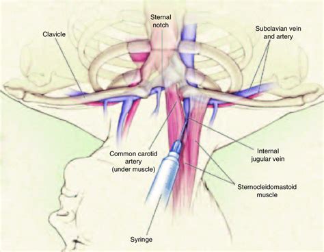 Placement of a central venous catheter in the right internal jugular... | Download Scientific ...