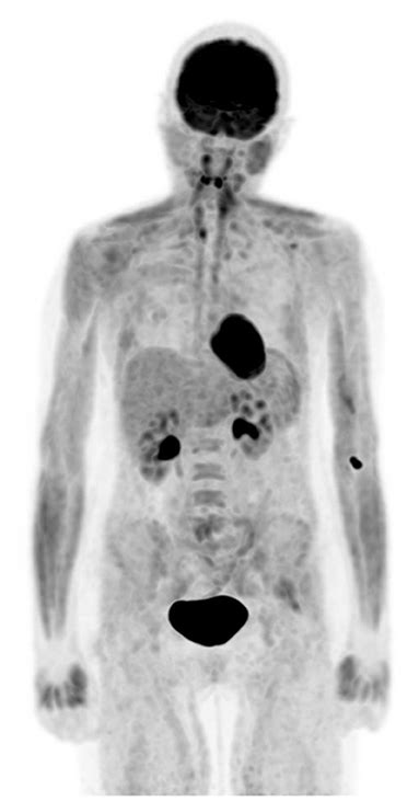 Pet Scan Images Of Lymphoma