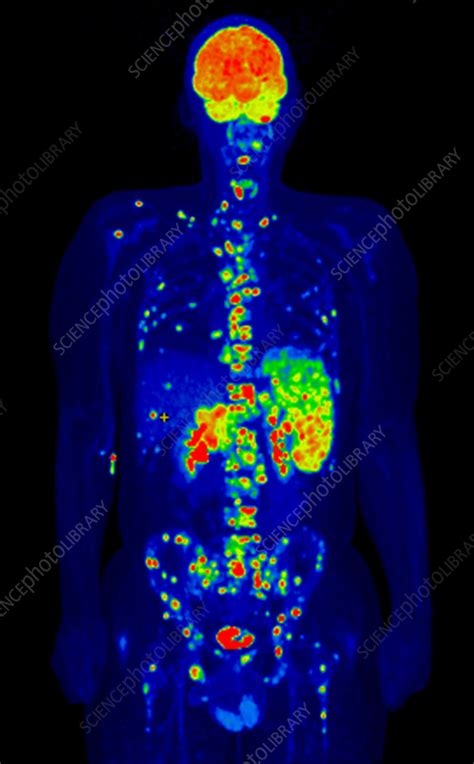 Hodgkin lymphoma, PET scan - Stock Image - C058/4831 - Science Photo ...