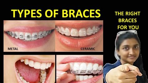 Types of braces -pros and cons|best braces for teeth - YouTube