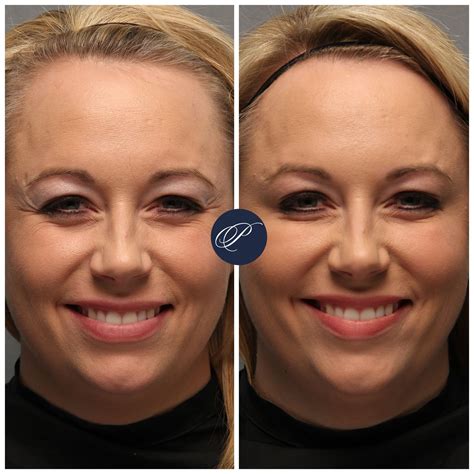 Injectable treatments are a beautiful thing for restoring tired eyes! This patient received # ...