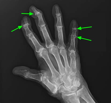 Bone Spur - Osteophytes, Causes, Signs, Symptoms & Treatment