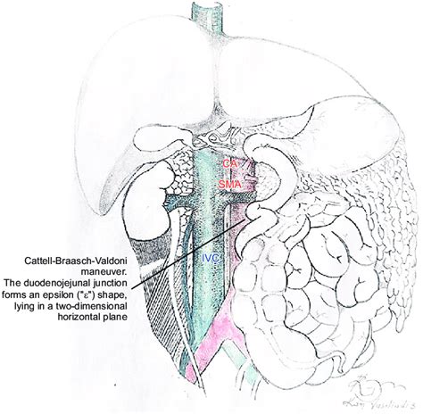 The Cattell-Braasch-Valdoni maneuver. Derotation in a 270-degree... | Download Scientific Diagram