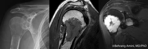 Roentgen Ray Reader: Multiple Myeloma: MRI Findings