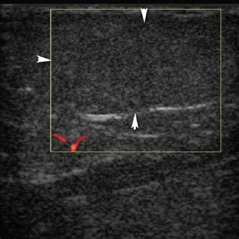 Neck Lipoma Ultrasound Images - Infoupdate.org