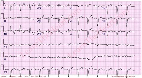 Right Axis Deviation ECG Example 1 | LearntheHeart.com