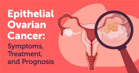 Epithelial Ovarian Cancer: Symptoms, Treatment, and Prognosis | MyOvarianCancerTeam