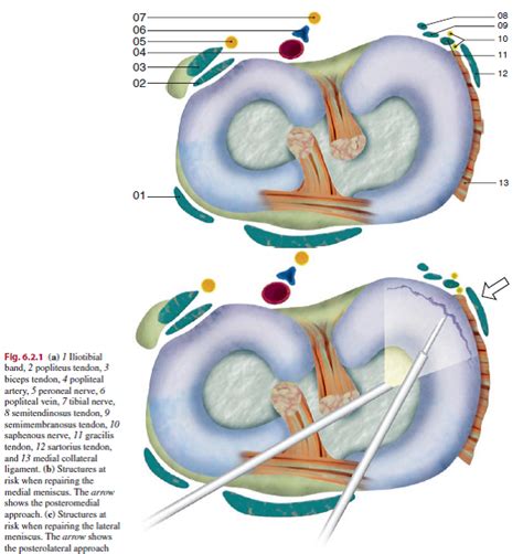 Meniscal Repair - Physiopedia