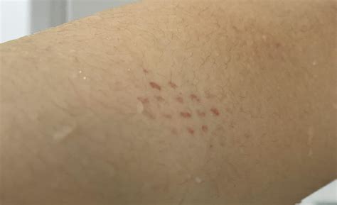 I woke up with these weird red dots on my arm : r/Weird