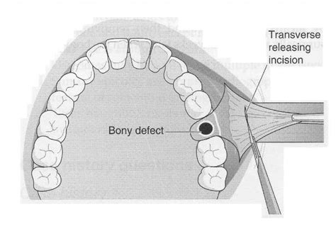 WizDent: Buccal advancement flap