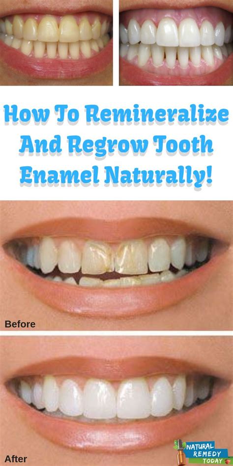 How To Remineralize And Regrow Tooth Enamel Naturally! | Health | Pinterest