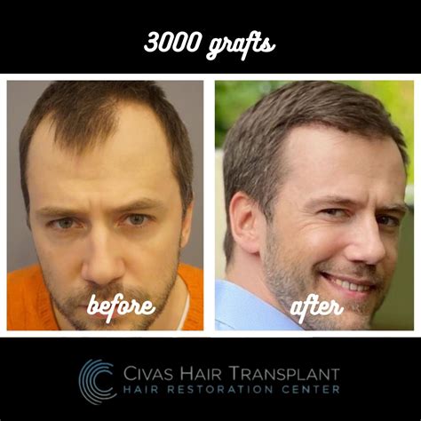 Dr. Ekrem Civas, MD - Before & Afters | IAHRS Member