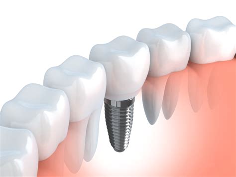 Dental Implants and Bridges in Boston Replace Missing Teeth - Brooks ...