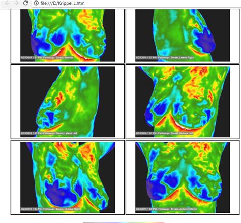 Not All Thermography Is Created Equally… - Breast Cancer Conqueror