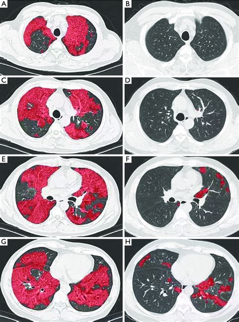 Chest HRCT images at the baseline and after 12 months of follow-up in a ...