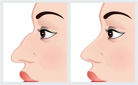 Steps to a Quick and Easy Botox Procedure - Popular RSS Feeds