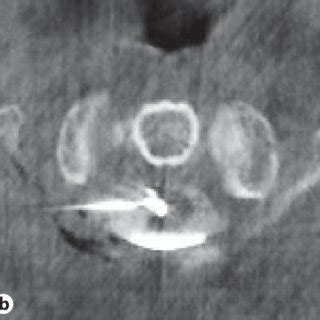 Stepwise procedure for the microendoscopic cordotomy technique. Step 1 ...