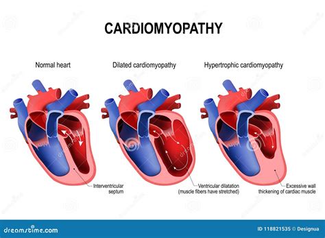 Hypertrophic Cardiomyopathy, Dilated Cardiomyopathy and Healthy Stock Vector - Illustration of ...