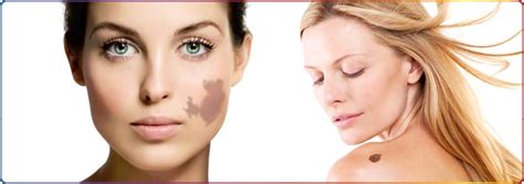 Laser Birthmark Removal: Remove Birthmarks, Port Wine Stains - Connecticut Skin Institute