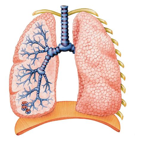 JRA.... Journal of a Radical Arthritis Chick: How do Lung nodules form from RA?