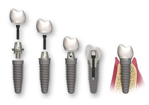 Dental Implant Types