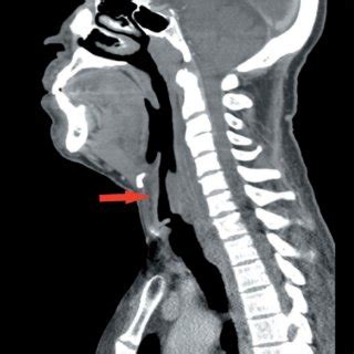 Axial contrast enhanced CT scan of neck soft tissue at the level of... | Download Scientific Diagram