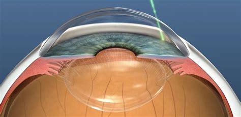 What is Glaucoma? Causes, Symptoms, Treatment | Dr Nathan Kerr