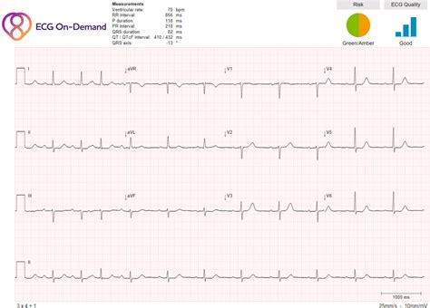 First degree AV block, 1 PAC, Sinus arrhythmia - Ambulatory ECG Holter monitoring - ECG On-Demand