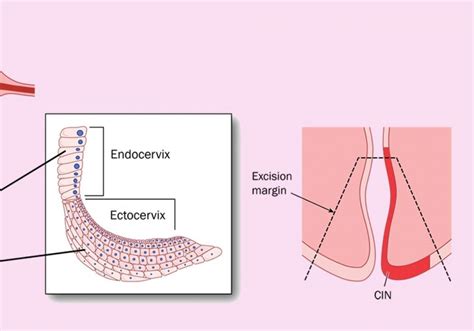 LLETZ Procedure and Cone Biopsy | London Obs and Gynae Clinic