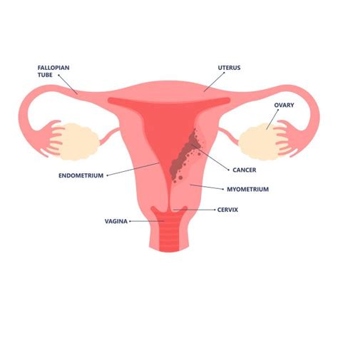 Endometrial Cancer Symptoms, Causes & Treatments | Vejthani