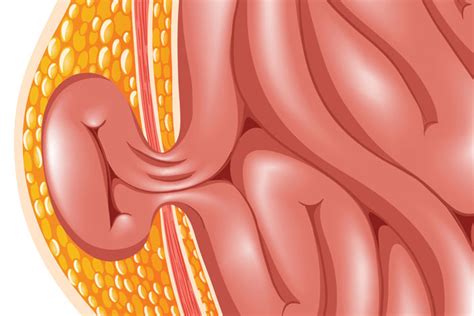 Hernia Program - Brigham and Women's Hospital