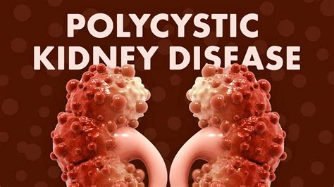 Polycystic Kidney Disease | Ausmed