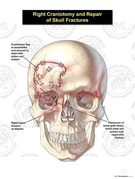 Right Craniotomy and Repair of Skull Fractures