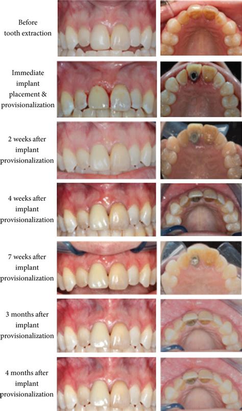 Clinical photos of tooth 11 before and after immediate implant... | Download Scientific Diagram