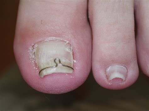 Ingrowing toenail correction with surgery & bracing | Foot Fix Clinic - Strathfield