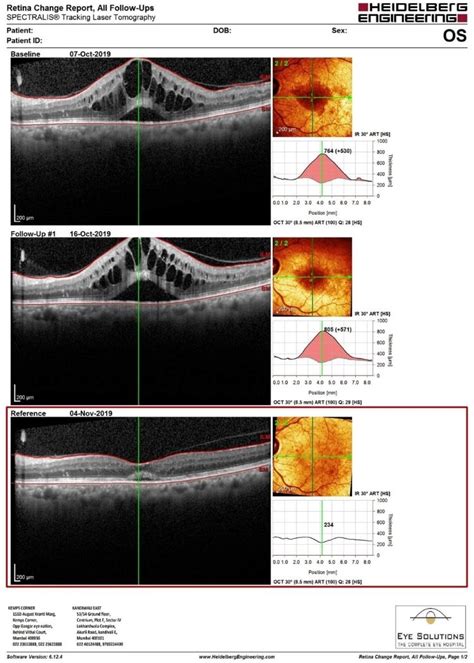 Normal Oct Images Of The Retina