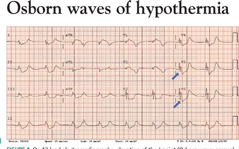 [PDF] Osborn waves of hypothermia | Semantic Scholar