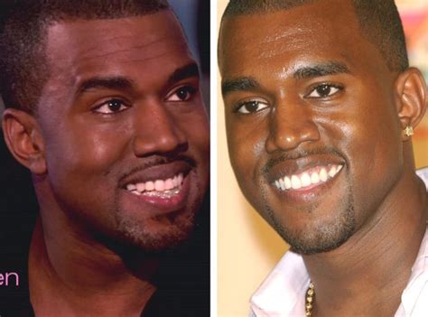 Kanye West Teeth Before And After Photos; Kanye West Replaces His Bottom Teeth With Diamonds