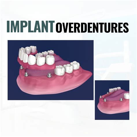 Understanding Implant Overdentures: Benefits, Procedure, and...