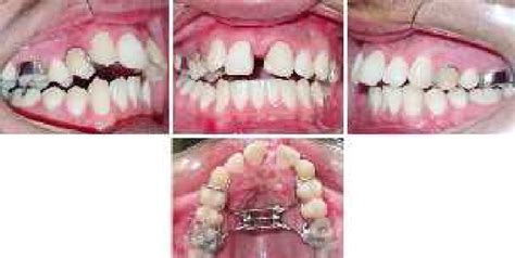 Intraoral view after activation of the Hyrax appliance. | Download ...