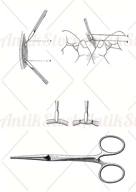 Surgery and medicine - hemostatic clamp - AntikStock