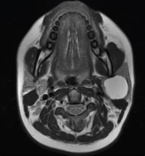 Type II First Branchial Cleft Cyst Presenting as Parotid Mass: A Case Report