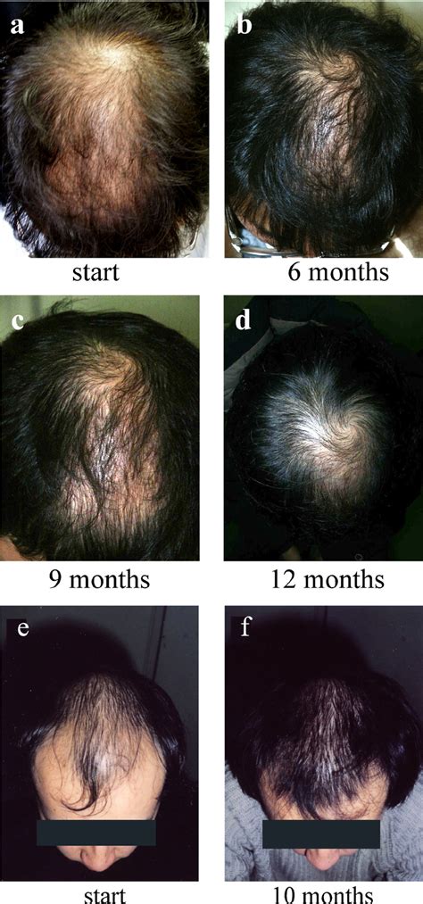 [PDF] Reversal of androgenetic alopecia by topical ketoconzole: relevance of anti-androgenic ...