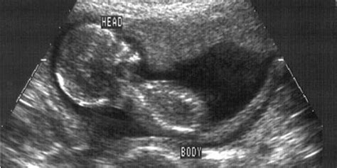 Breech Presentation Ultrasound