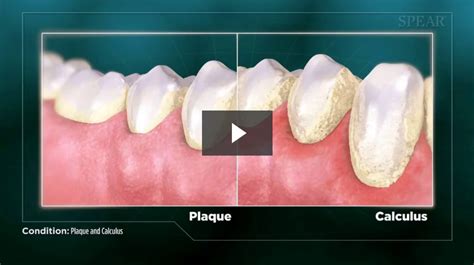 Plaque and Calculus - Westney